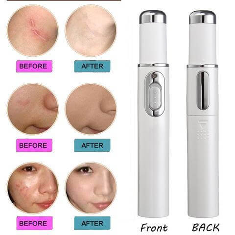 Before and after images showing results of blue light therapy acne laser pen, with the device displayed from front and back.